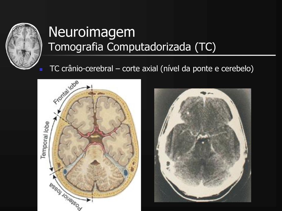 crânio-cerebral corte