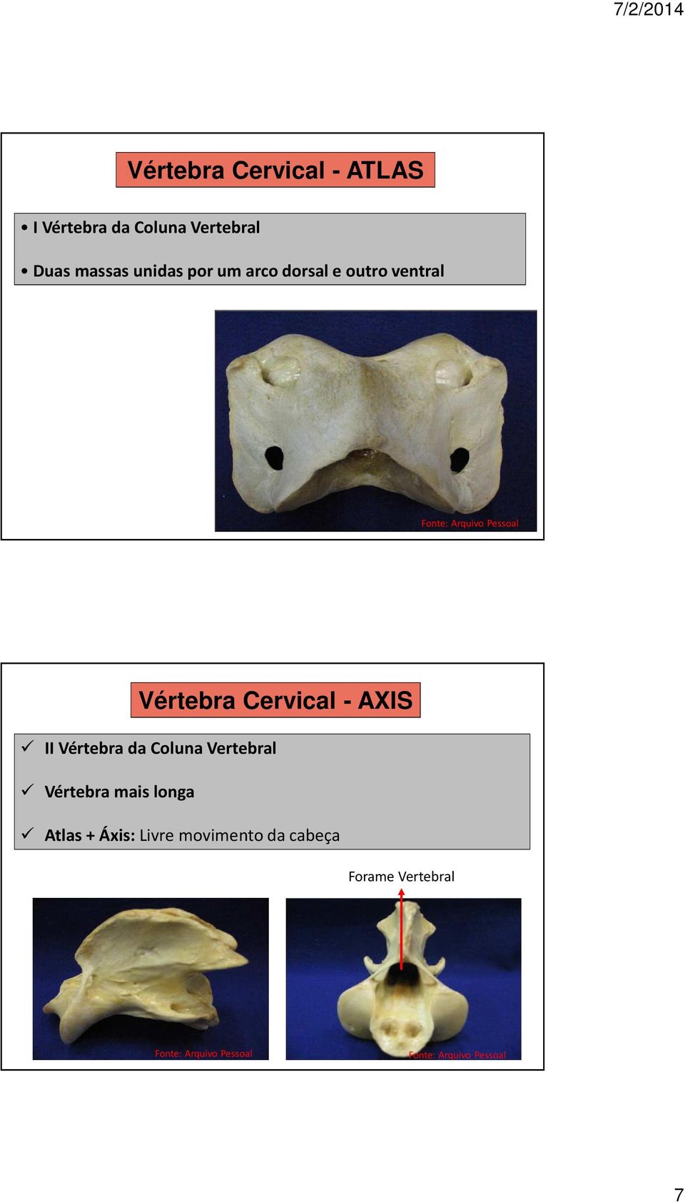Cervical - AXIS II Vértebra da Coluna Vertebral Vértebra mais