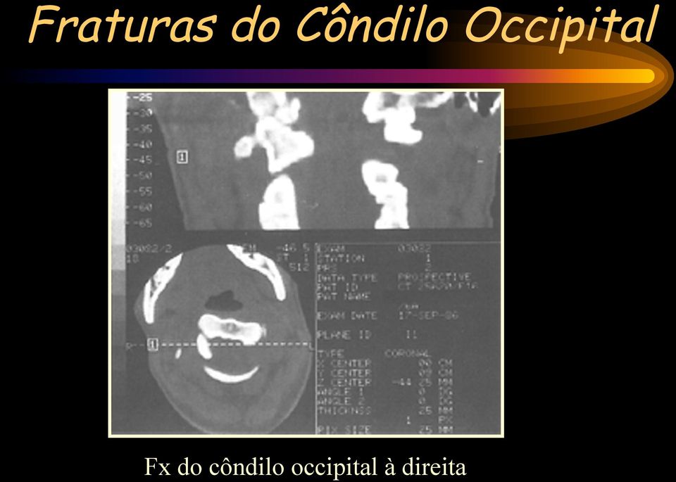 Occipital Fx do