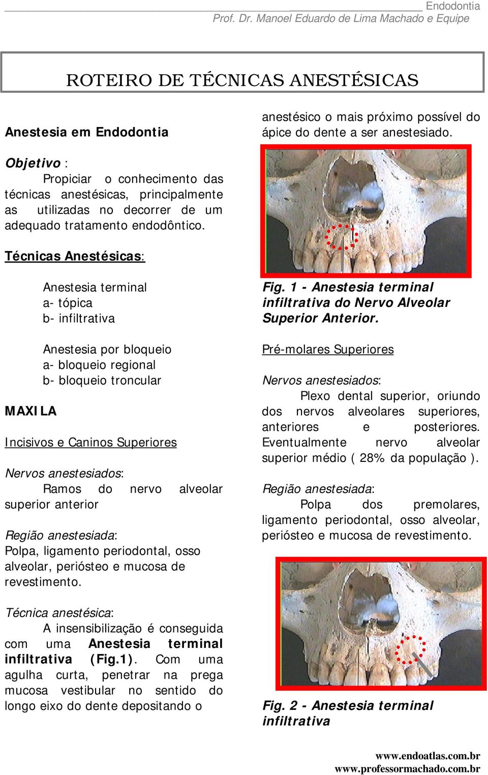 Técnicas Anestésicas: MAXILA Anestesia terminal a- tópica b- infiltrativa Anestesia por bloqueio a- bloqueio regional b- bloqueio troncular Incisivos e Caninos Superiores Ramos do nervo alveolar