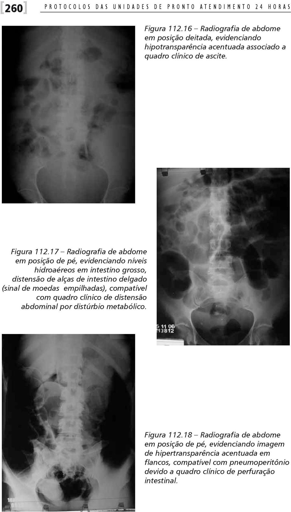 17 Radiografia de abdome em posição de pé, evidenciando níveis hidroaéreos em intestino grosso, distensão de alças de intestino delgado (sinal de moedas empilhadas),