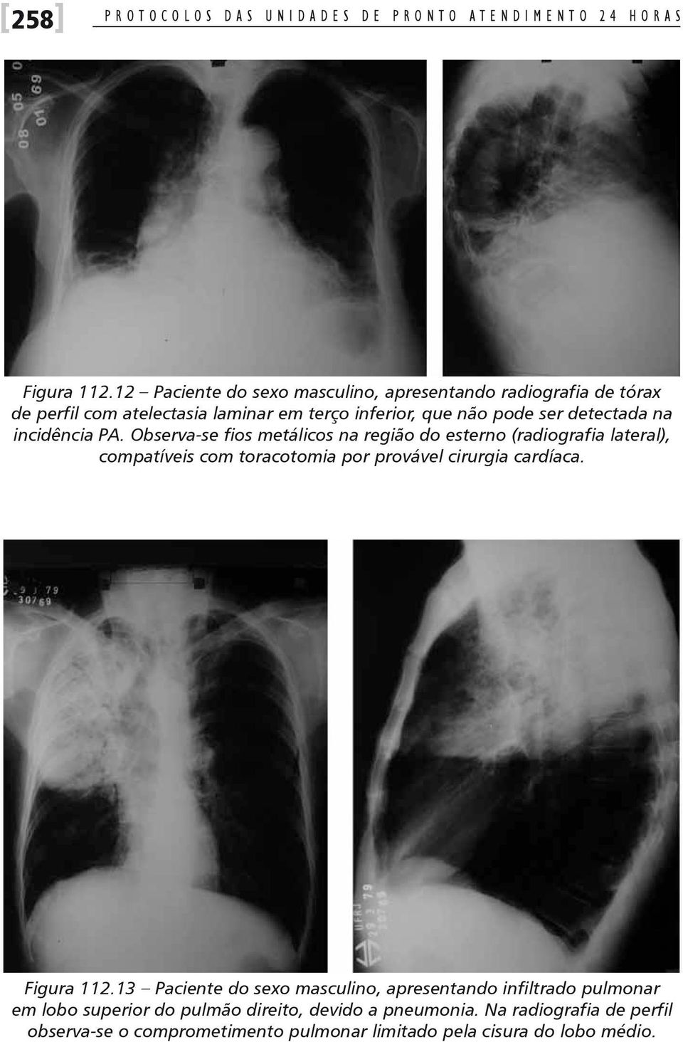 PA. Observa-se fios metálicos na região do esterno (radiografia lateral), compatíveis com toracotomia por provável cirurgia cardíaca. Figura 112.
