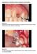 Manipulação de Tecido Mole ao Redor de Implantes na Zona Estética