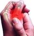 Normas de cuidados para as pessoas com artrite reumatóide